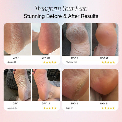 Dermave™ - Electric Foot Callus Remover